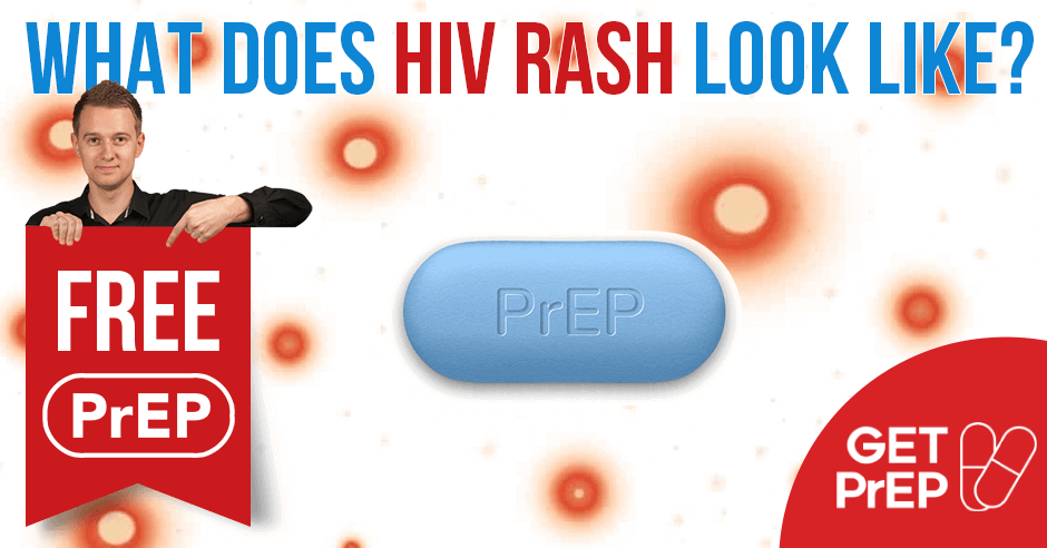 All necessary information about HIV rash